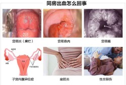 怀孕后宫颈息肉出血怎么办,孕期息肉出血对胎儿有影响吗