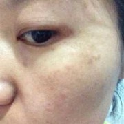 脸上孕斑怎么去除,孕期妊娠斑生完会掉吗