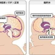 孕妇胎儿脑积水怎么办（孕妇胎儿脑积水怎么办呢）