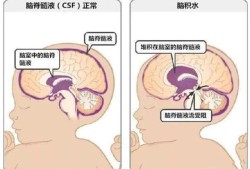 孕妇胎儿脑积水怎么办（孕妇胎儿脑积水怎么办呢）