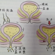 孕期压迫膀胱（孕期压迫膀胱）