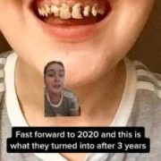 孕妇的的牙齿掉了怎么办,孕期掉牙齿有什么预兆