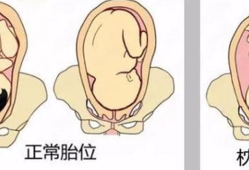 胎儿双顶径96能顺产吗（胎儿双顶径96能顺产吗视频）