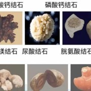 孕妇肾结石伴又肾积水如何治疗?孕中期时候，对胎儿有什么危害,孕妇肾酸痛