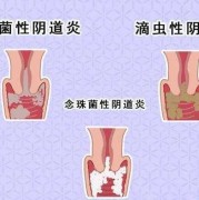 怀孕外阴瘙痒影响胎儿