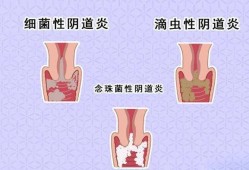 怀孕外阴瘙痒影响胎儿