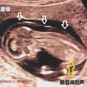 胎儿长肿瘤（胎儿长肿瘤的原因）