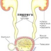孕期肾积水怎么办（畸形筛查胎儿肾积水怎么办）