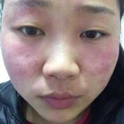皮肤过敏，说用生理盐水外敷，脸红红的还有点刺痛,孕期皮肤容易过敏怎么回事?