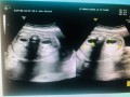 胎儿右肾集合系统分离（胎儿右肾集合系统分离0.5cm正常吗）