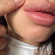 有孕期长了口唇疱疹的吗,孕期嘴唇长疱疹怎么办才好得快