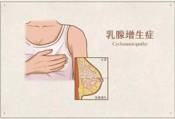 孕期乳房胀痛有硬块（哺乳期乳房里有硬块是怎么回事）
