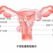 孕期肌瘤疼（孕期肌瘤疼痛多久会缓解）
