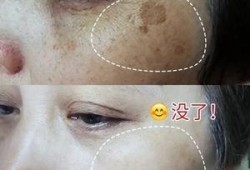 孕期脸上的斑怎么去除（孕期脸上的斑怎么去除小妙招）