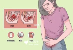 子宫脱垂是怎么回事,孕期子宫脱垂的症状是什么