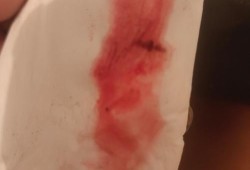 孕期流血有哪些原因（先兆流产流血量图片）