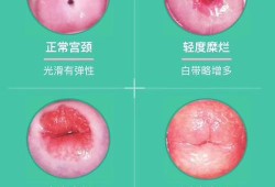 孕期宫颈糜烂会出血吗（孕期宫颈糜烂会出血吗怎么办）