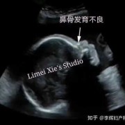 胎儿鼻骨长标准对照表（23周胎儿鼻骨长标准对照表）