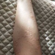 怀孕了得荨麻疹怎么办,孕妇有荨麻疹会不会影响胎儿