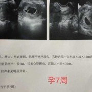 孕囊是胎儿吗（孕囊的读音）