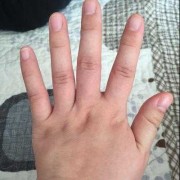 孕期手肿（孕期手肿胀握拳有紧绷感觉）