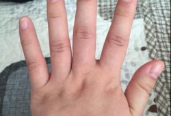孕期手肿（孕期手肿胀握拳有紧绷感觉）