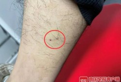 怀孕期间被狗咬了（怀孕期间狗咬了对宝宝有影响吗）