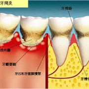 孕期牙周炎怎么治疗（孕期牙周炎怎么治疗）