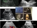 胎儿系统性彩色多普勒超声筛查（胎儿系统性彩色多普勒超声筛查几周做）