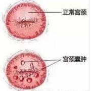 宫颈肥大影响胎儿吗（子宫颈肥大什么意思）