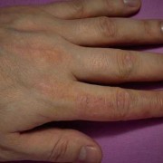 孕期指尖疼（孕期指尖疼）