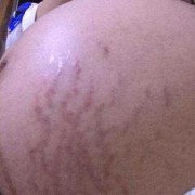 孕期妊娠线什么时候长（孕期妊娠线什么时候长出来）