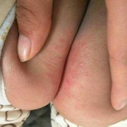 孕期臀部湿疹（小儿屁股湿疹）