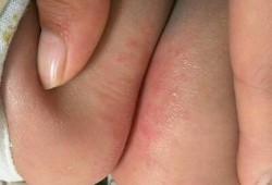 孕期臀部湿疹（小儿屁股湿疹）