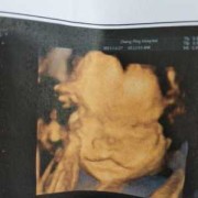 四维彩超兔唇怎么办,后悔引产唇腭裂胎儿怎么办