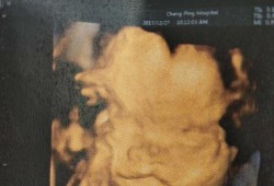 四维彩超兔唇怎么办,后悔引产唇腭裂胎儿怎么办