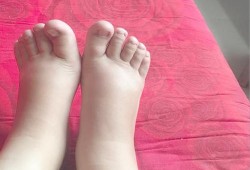 整个孕期脚没肿（脚扭了,没肿,怎么办）