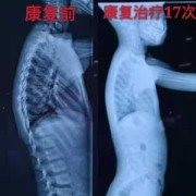胎儿脊椎侧弯（胎儿脊椎侧弯）
