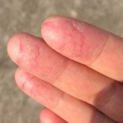 孕期手指脱皮（谁知道孕妇的腿上脱皮比较严重，应该怎么办）