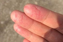 孕期手指脱皮（谁知道孕妇的腿上脱皮比较严重，应该怎么办）