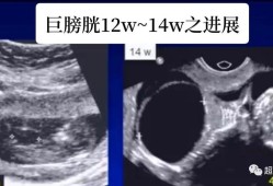 巨膀胱胎儿 原因（巨膀胱胎儿 原因）