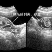 绒毛膜下出血是怎么回事,胎儿绒毛检查能检查出什么