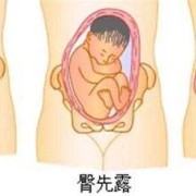 胎儿在肚子里翘屁股图（胎儿在肚子里翘屁股图片大全）