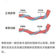 孕12周了检查宝宝是单脐动脉是怎么回事,胎儿有几条脐动脉和脐静脉