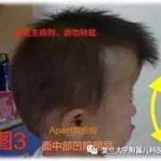 婴儿什么时候长大脑,胎儿小脑发育不良是什么原因造成的