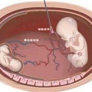 孕期减胎（孕期减胎对另一个有影响吗）