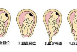 胎儿臀位图片几种姿势（胎儿臀位图片几种姿势）