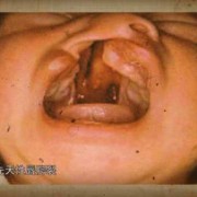唇腭裂的孩子是怎么造成的,造成胎儿唇裂的主要原因
