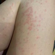 孕期长疹子（孕晚期身上起了很多疹子怎么办，可以抹药吗）