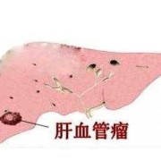 胎儿肝脏血管瘤怎么办,如何预防胎儿血管瘤形成原因